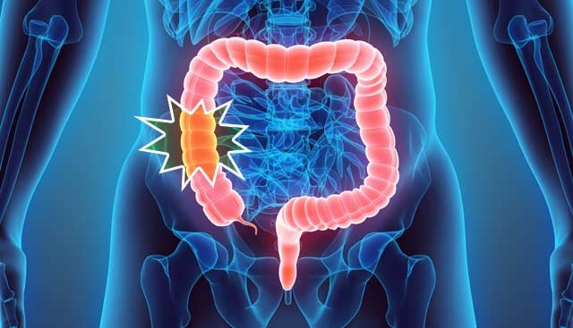 João Pessoa realiza Mutirão de Prevenção do Câncer Colorretal no Hospital Universitário