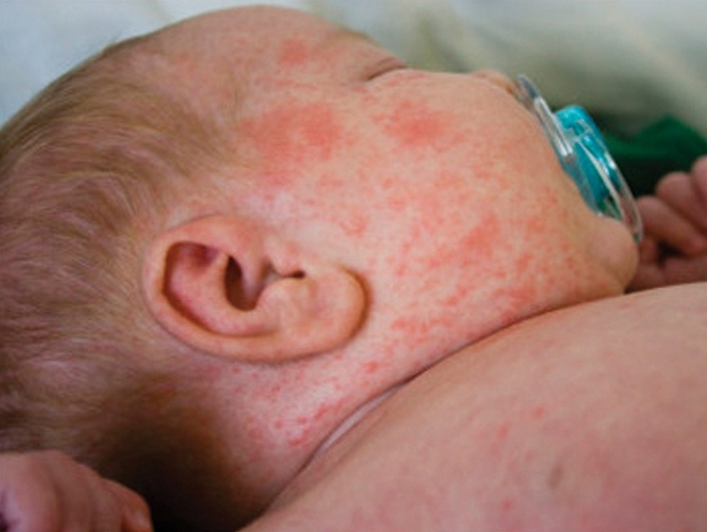 VACINAÇÃO: Ministério da Saúde inicia nesta segunda vacinação contra sarampo em crianças de 6 meses a 5 anos