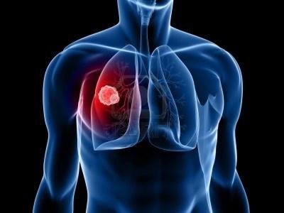 Tabagismo é a principal causa de câncer de pulmão, o que mais mata no Brasil e no Mundo