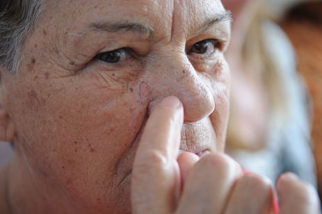 Saúde realiza neste sábado "mutirão" para diagnóstico precoce de câncer de pele em todo o país