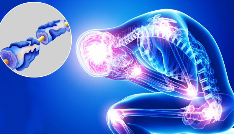 Guillain-Barré; Síndrome rara causada pela Covid-19 ataca o sistema nervoso