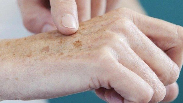 No Dezembro Laranja, Prefeitura de João Pessoa oferece atendimento e tratamento para pessoas com câncer de pele