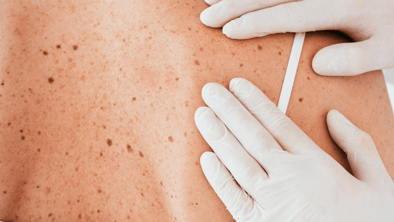 Dezembro Laranja, Brasileiros devem redobrar cuidados no verão contra câncer de pele