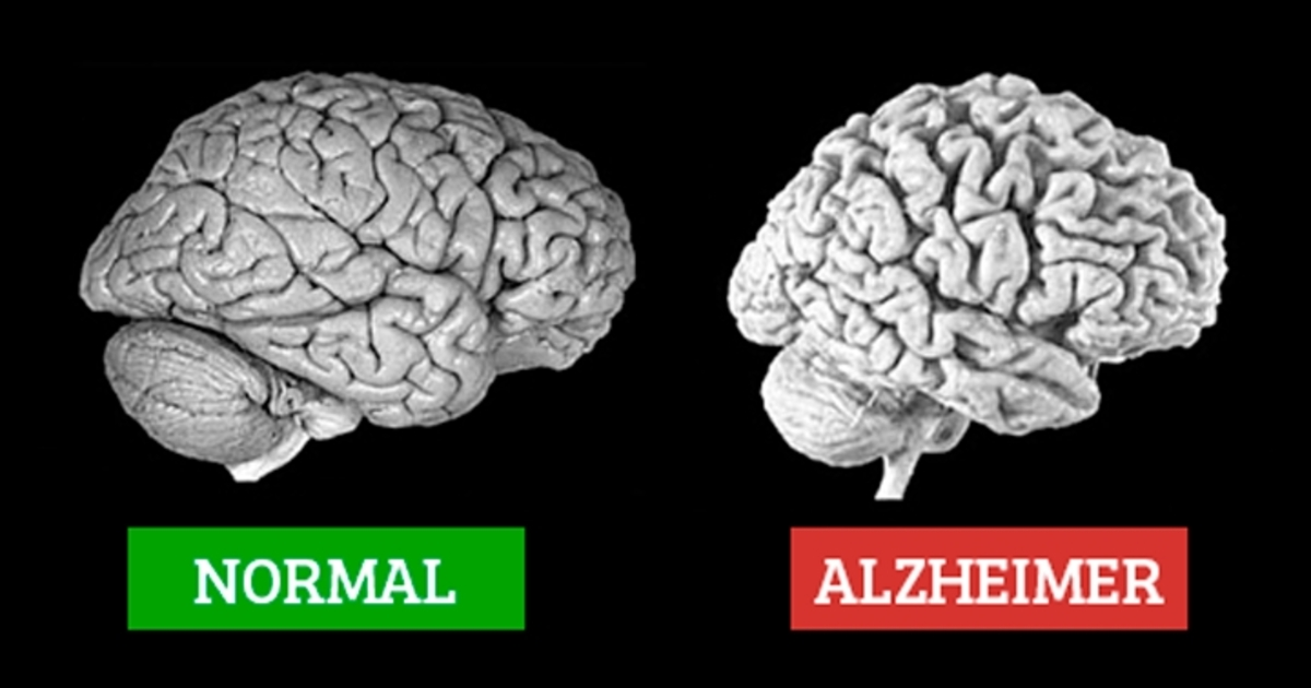 Doença degenerativa: tire dúvidas de Alzheimer e Parkinson - 15/11/2023 -  Equilíbrio e Saúde - Folha